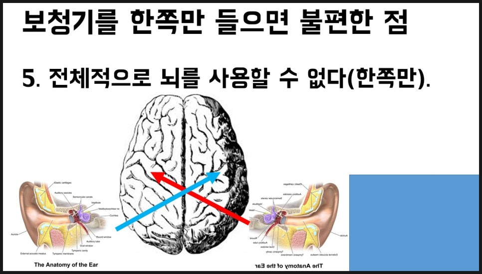 보청기 양쪽 착용의 중요성 22